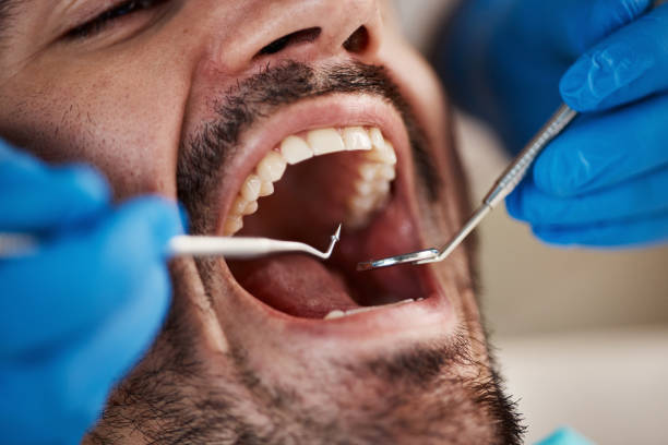 Best Knocked-Out Tooth (Avulsed Tooth) Treatment in Blanchester, OH
